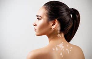 Vitiligo_depilacion_laser